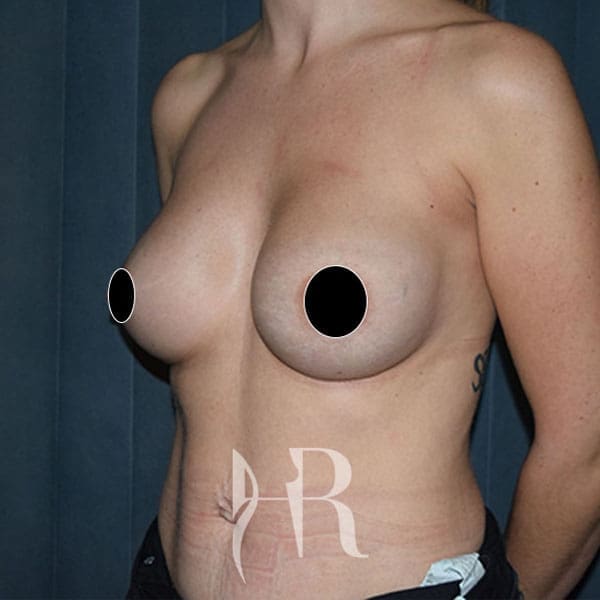 HR Plastic Surgery - Breast Enlargement patient after 2